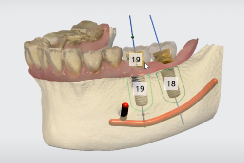 навигационный шаблон для имплантации зубов